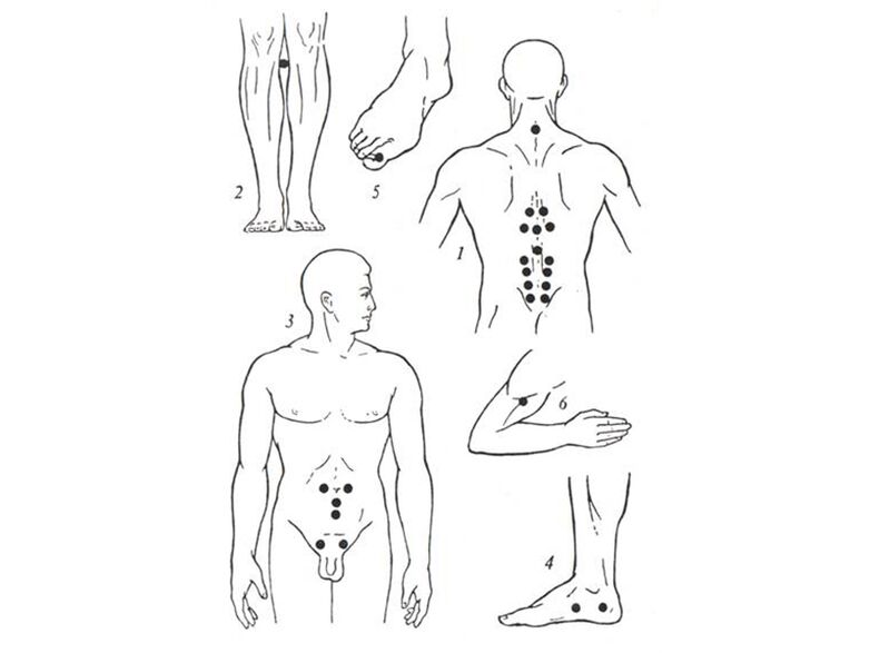 Acupuncture